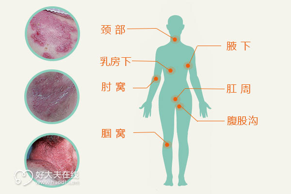 天疱疮最新治疗方法探讨