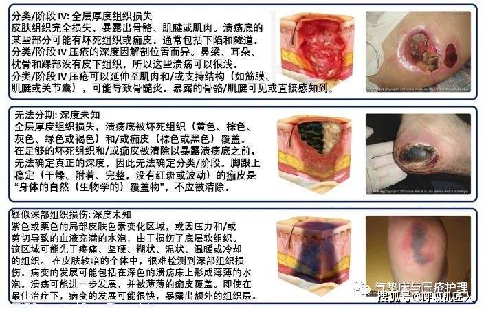 压疮最新分期及其临床意义解析